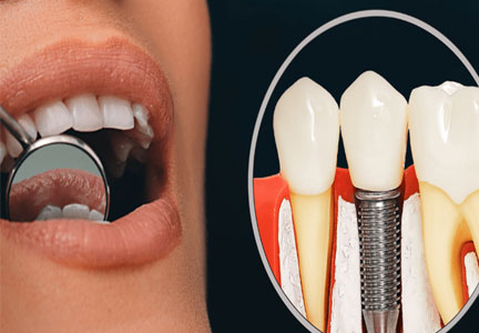 Best Implant Dentist in Vadodara, Gujarat, India – Swastik Dental Clinic