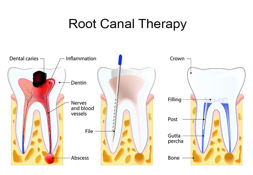 Root Canal Treatment in Vadodara, Gujarat – Swastik Dental Clinic